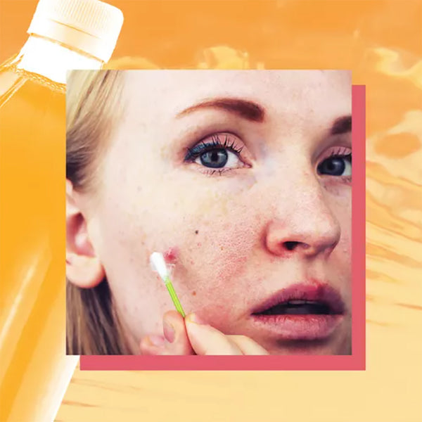 Can Using Apple Cider Vinegar for Acne Actually Prevent Zits?