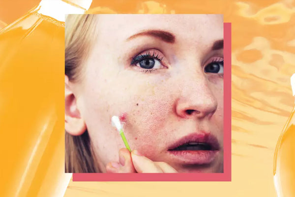 Can Using Apple Cider Vinegar for Acne Actually Prevent Zits?